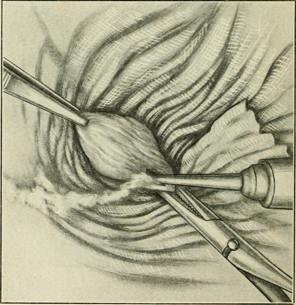 Chirurgie laser des hémorroïdes (Hémorroïdectomie),