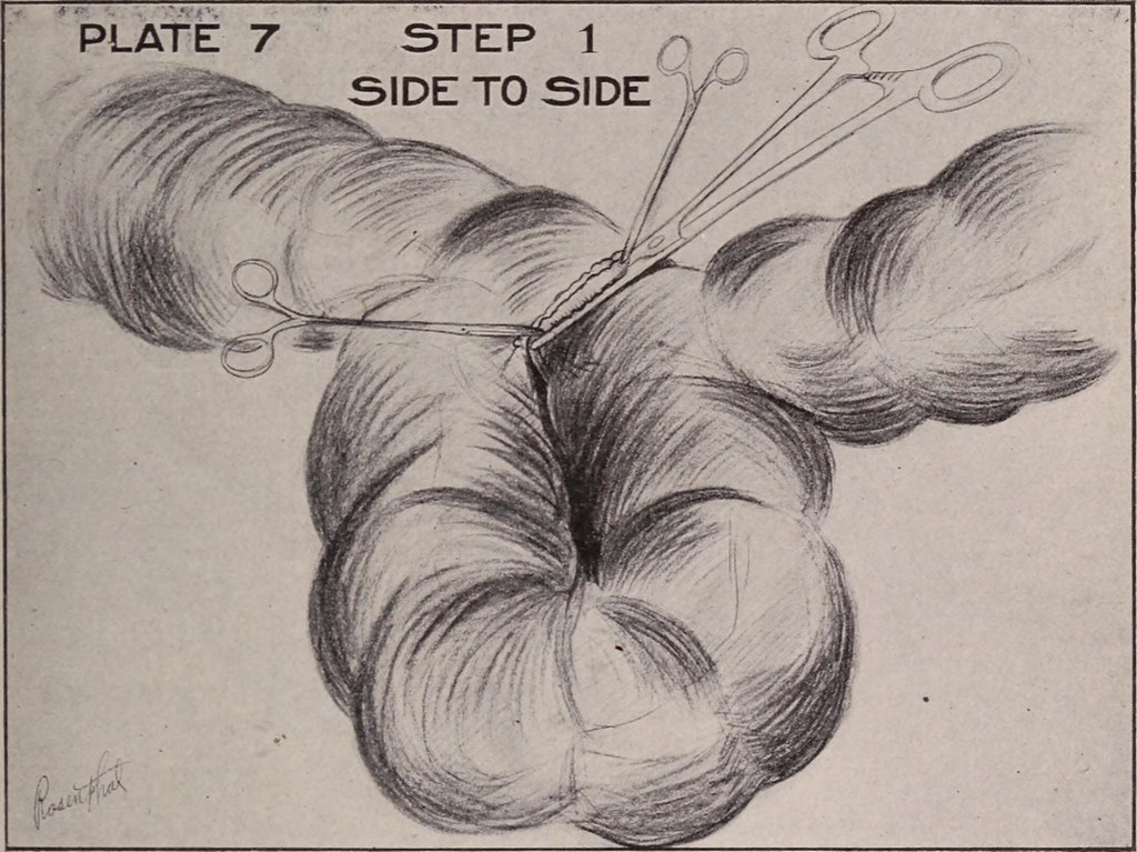 Résection ‍de l'intestin grêle,