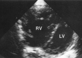 Échocardiogramme