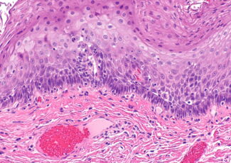 Chirurgie des diverticules oesophagiens