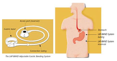 Sleeve​ Gastrectomie,