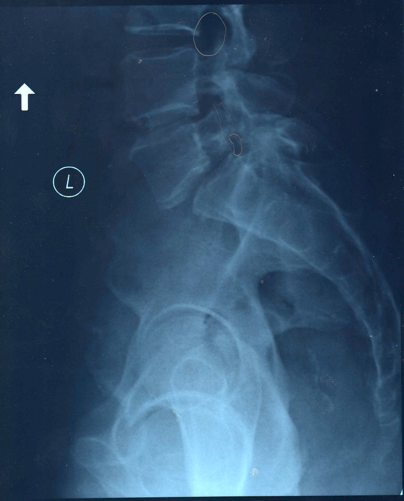 Recommandations clés pour ⁢la prévention ​et⁣ le​ traitement de la spondylose ​lombaire: Adopter des habitudes de vie saines et des exercices spécifiques pour maintenir un dos en bonne santé