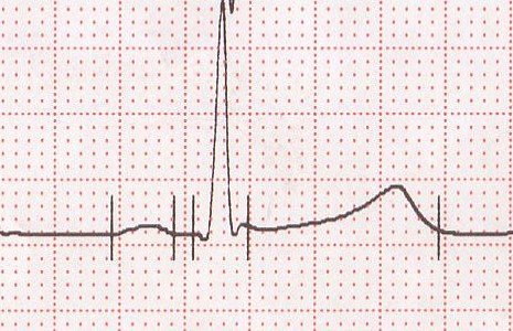 Electrocardiographie D'Effort,