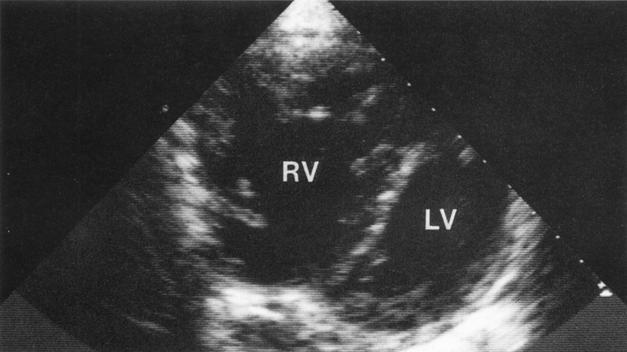 Échocardiogramme,