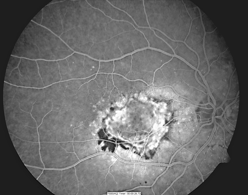 La lumière éclatante de l'Angiographie​ Fluorescéine : Découvrez ses ⁤incroyables avantages pour le‍ diagnostic précoce des maladies oculaires