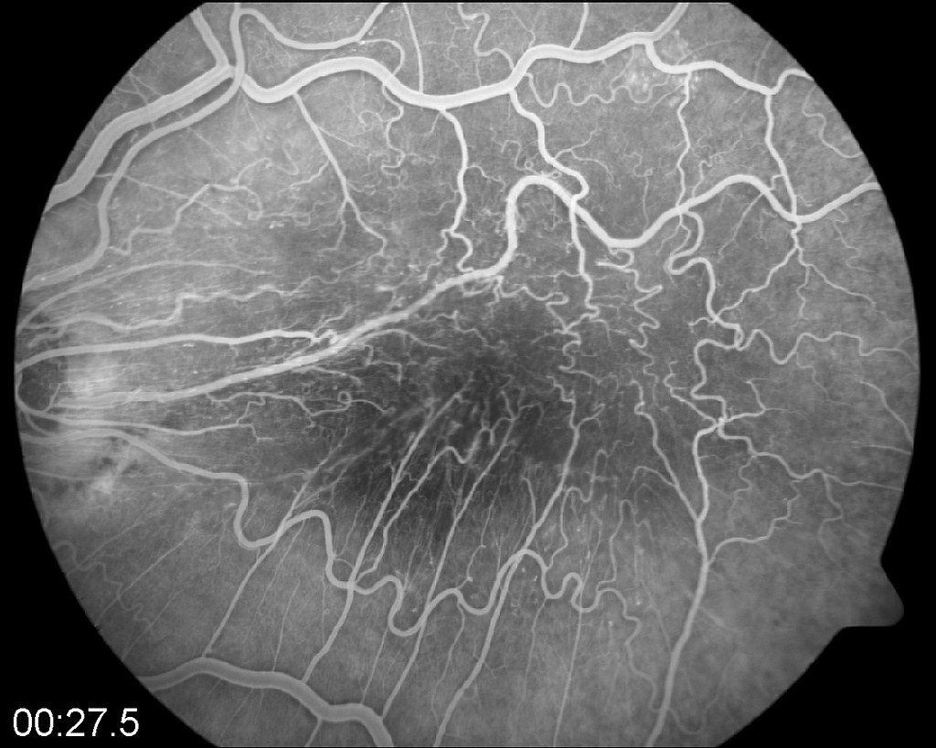 Le pouvoir de l'Angiographie Fluorescéine :‌ Une ⁤standpoint inspirante sur son impact transformateur ​dans le domaine de l'ophtalmologie