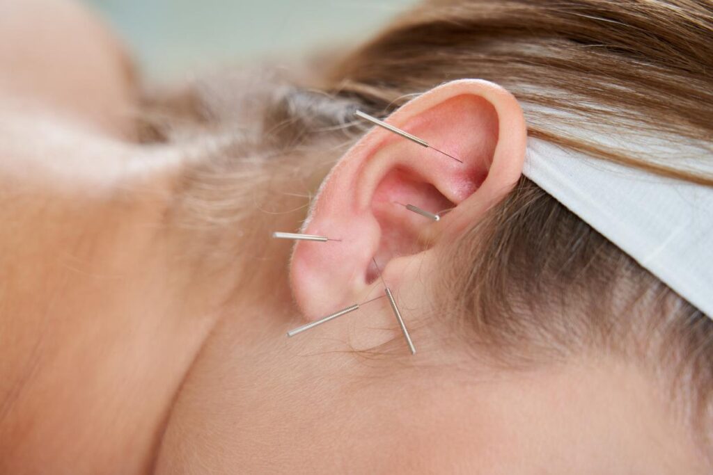 Acupuncture Oreilles Et Corps