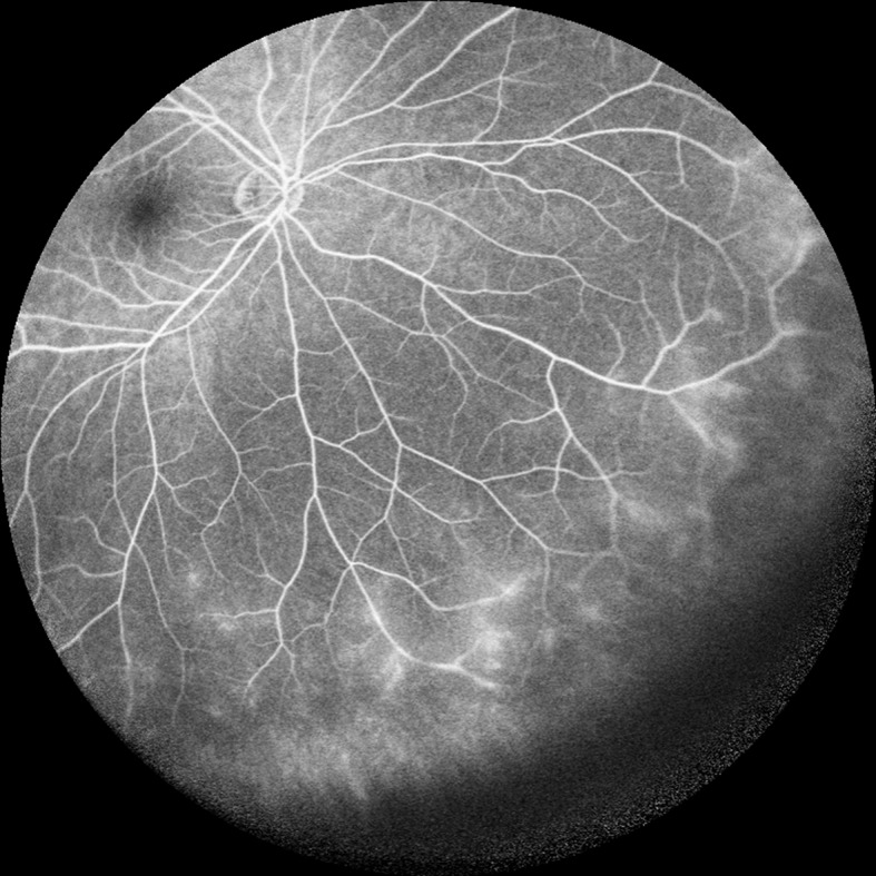 Les secrets and tactics de l'Angiographie Fluorescéine révélés :‍ Une exploration en profondeur des tactics⁤ et des ⁢résultats révolutionnaires