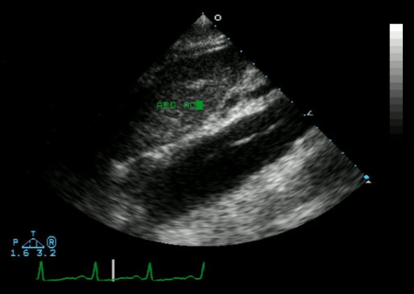 Échocardiogramme,