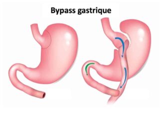 Bypass Gastrique