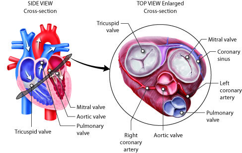 Remplacement valvulaire aortique par voie transcathéter (TAVI),