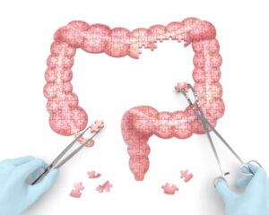 Chirurgie De La Diverticulose