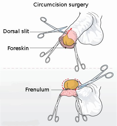 La circoncision ​: Une custom millénaire‍ au service ⁢de la santé masculine