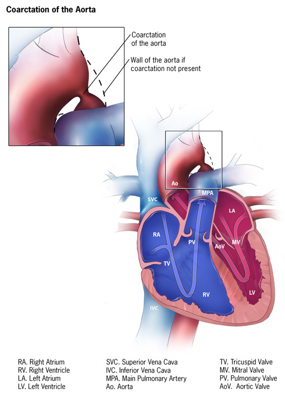 Cardiopathie Congénitale,