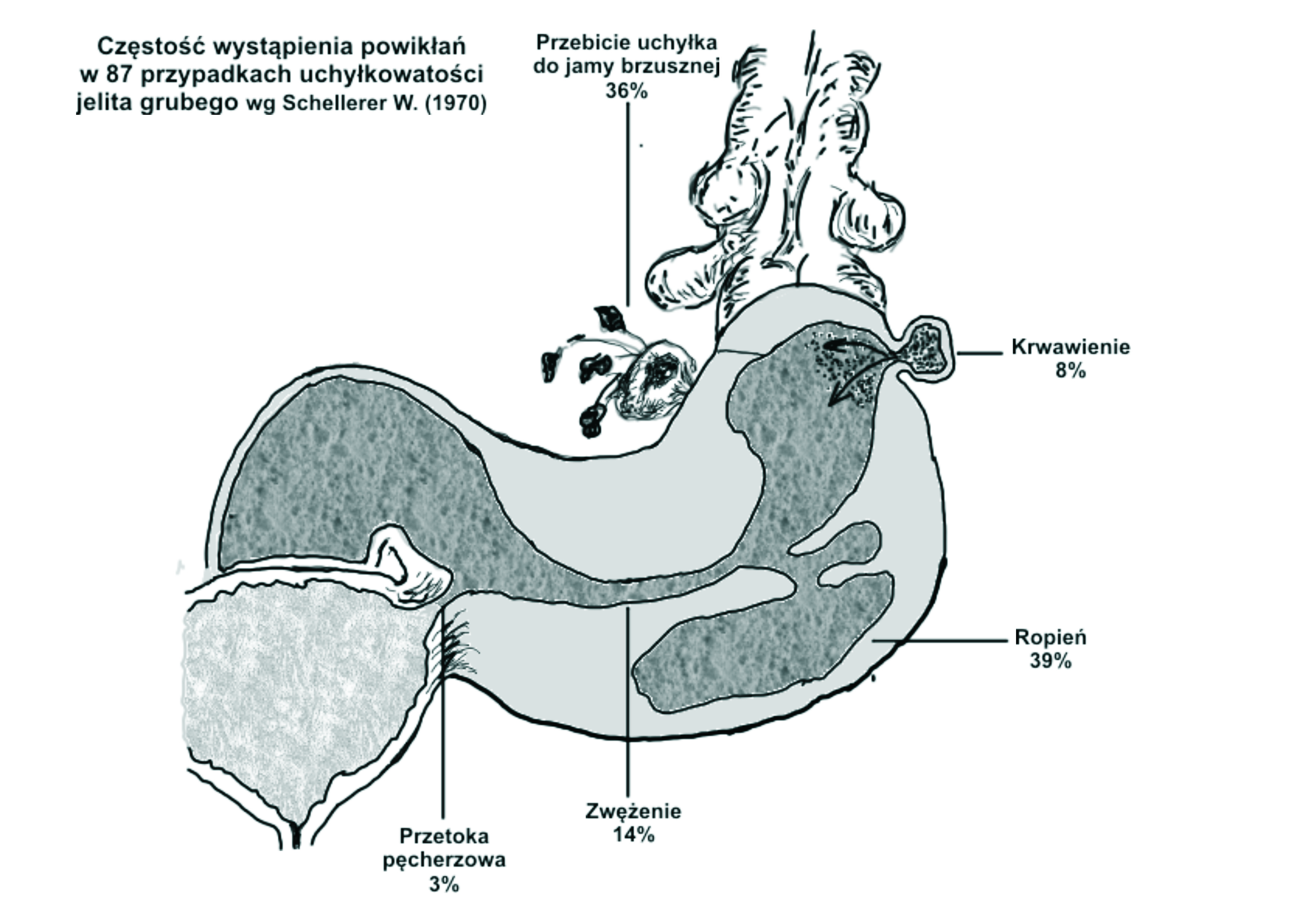 Traitement de ‍la diverticulite,