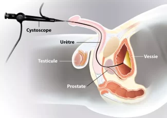 Cystoscopie