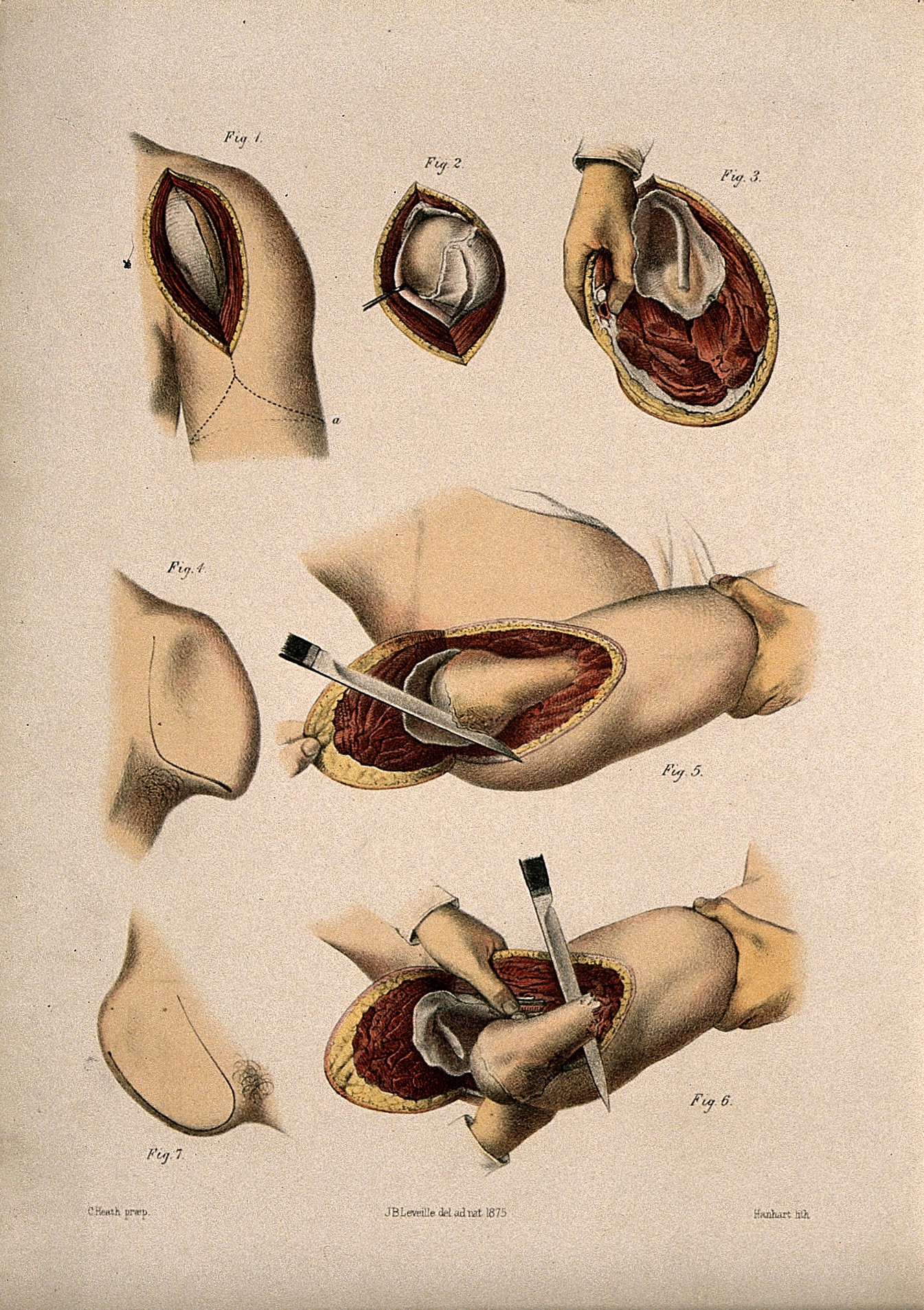 Excision ⁤Endoscopique De‍ La Muqueuse,