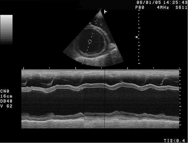 Cardiomyopathie,