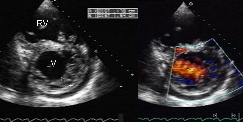 Cardiomyopathie,