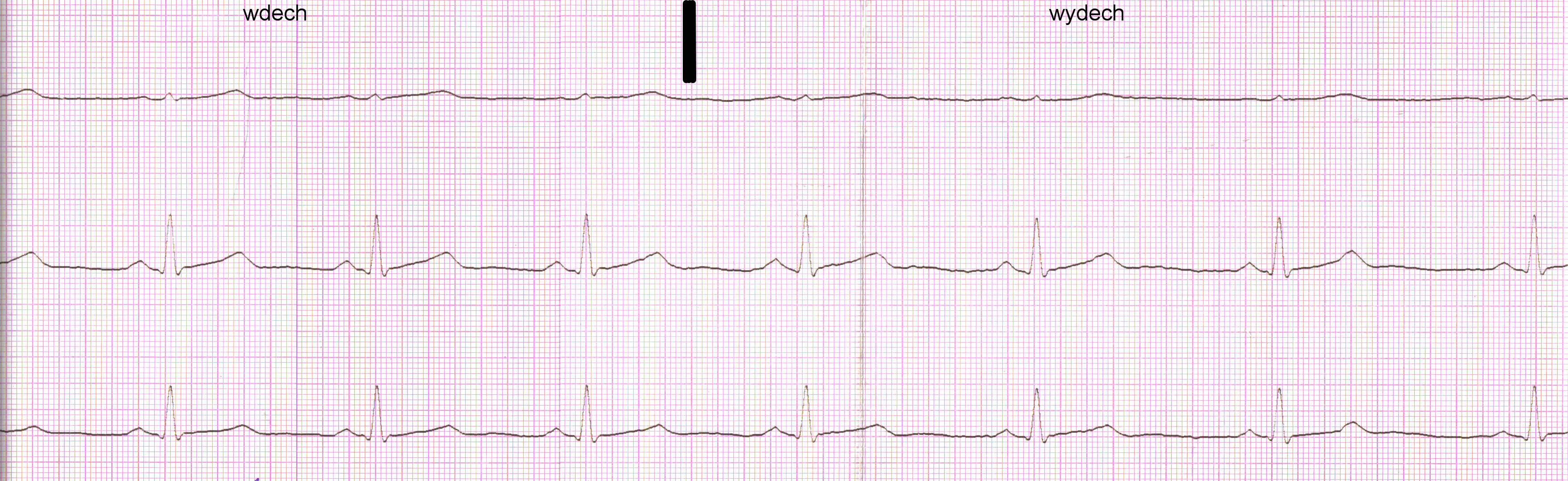 Electrocardiographie ​D'Effort,