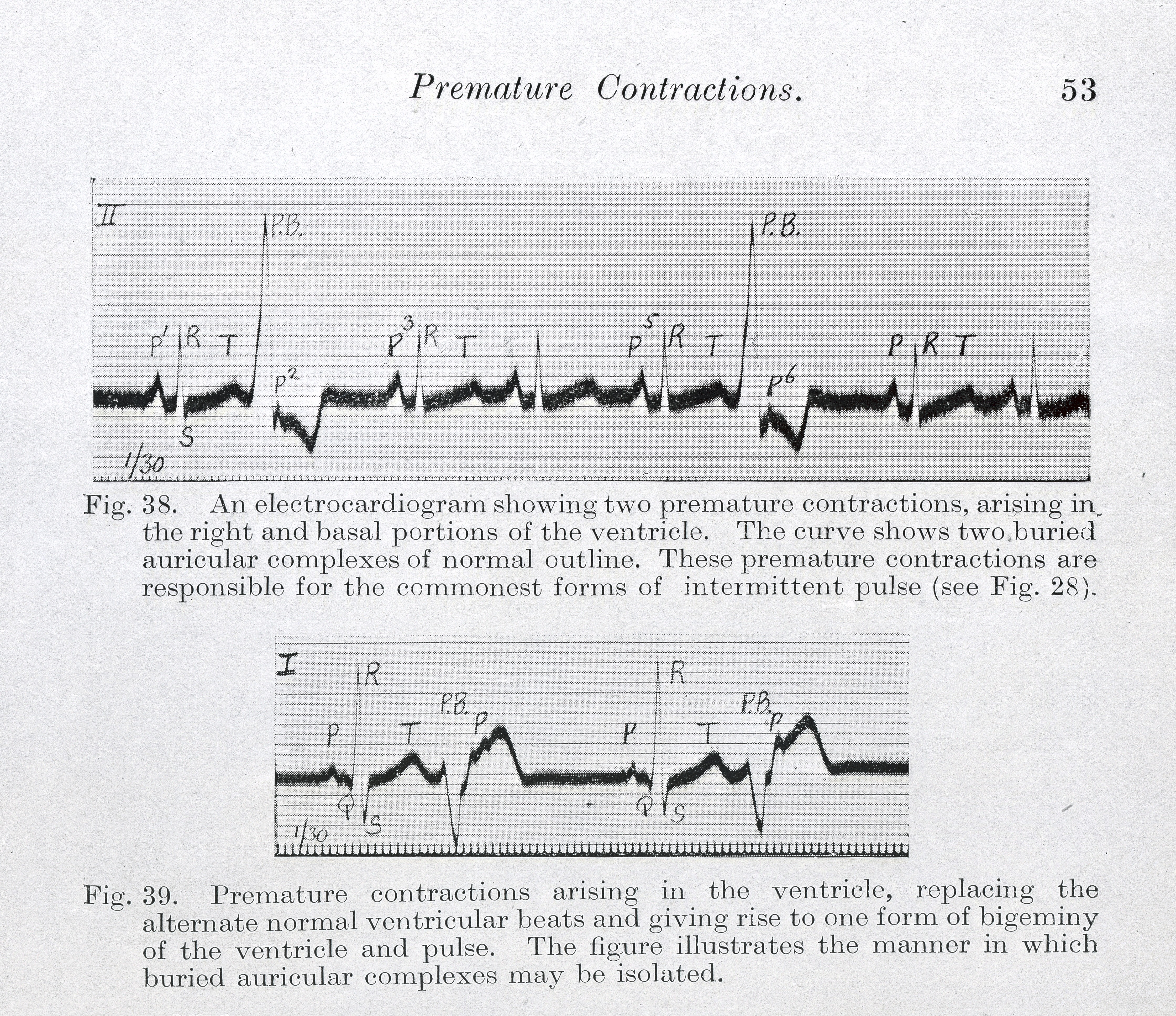 Electrocardiographie D'Effort,