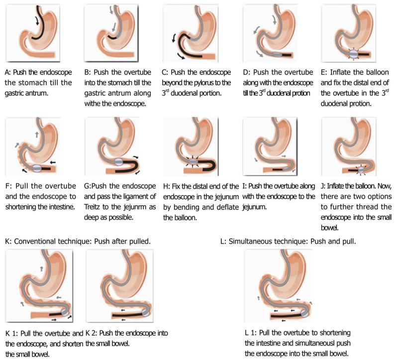 Ballon gastrique Elipse,