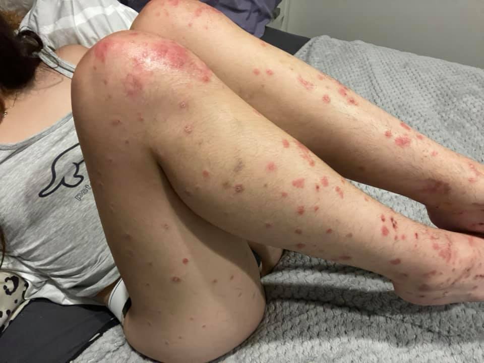 Adoptez une angle sure et réalisez votre potentiel malgré ‍le ⁢psoriasis