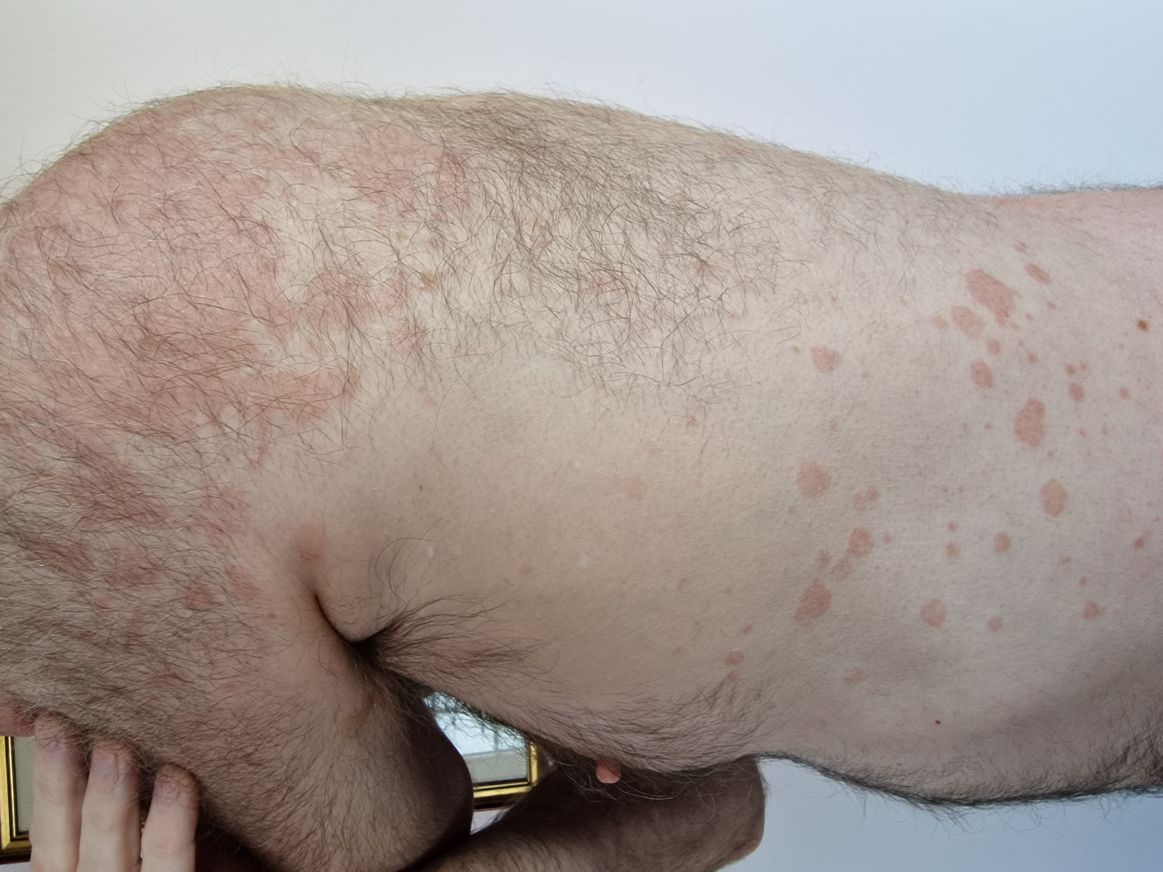 Découvrez des traitements novateurs‌ pour contrôler la psoriasis et retrouver une​ peau éclatante