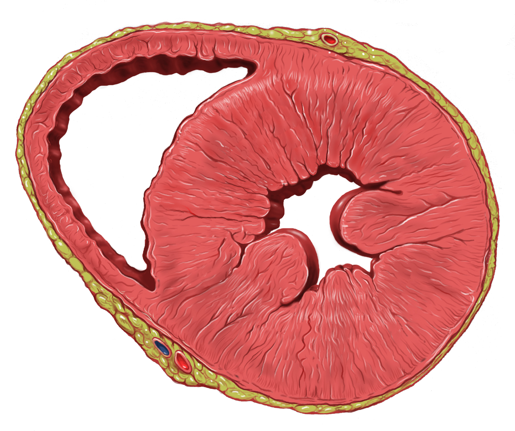 Cardiomyopathie,