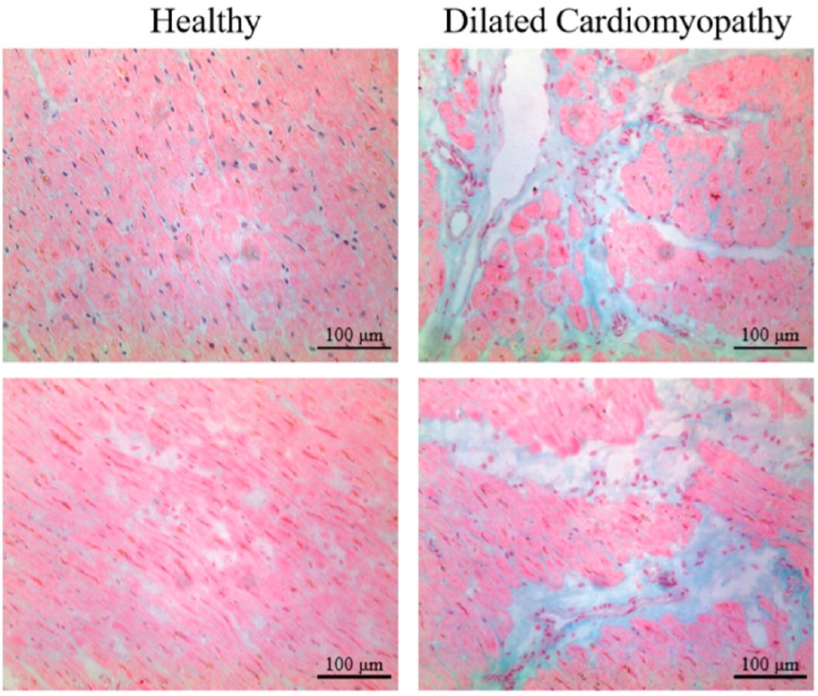 Cardiomyopathie,