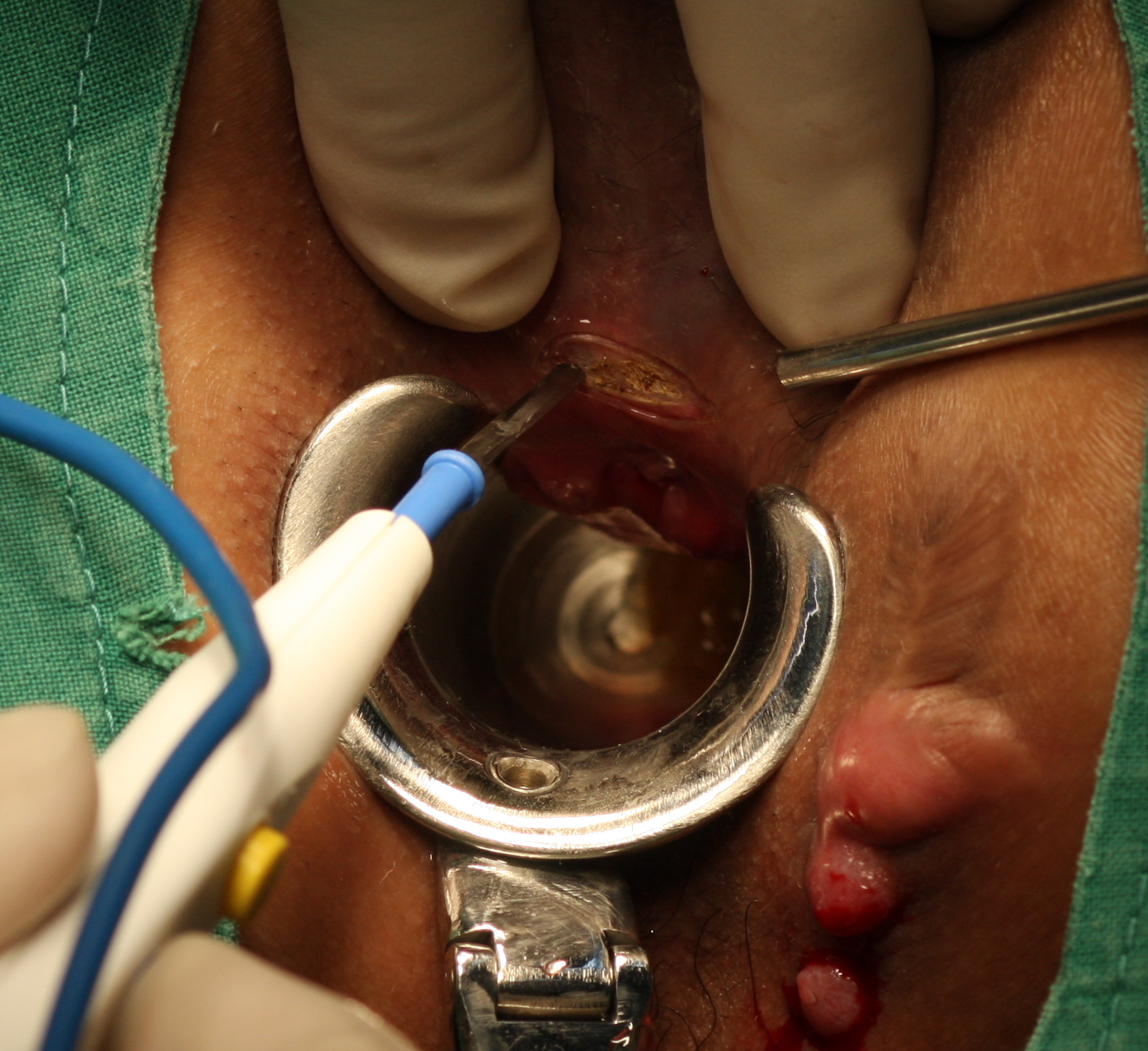 Chirurgie Colorectale,