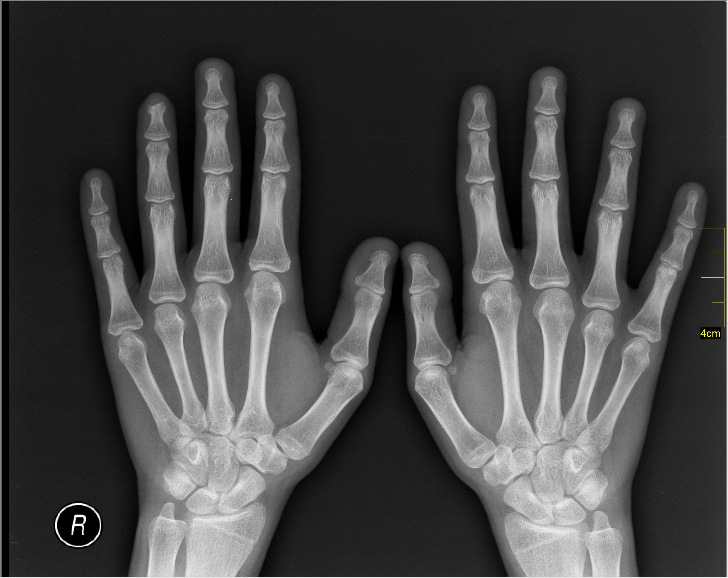 Radiographie de la poitrine,