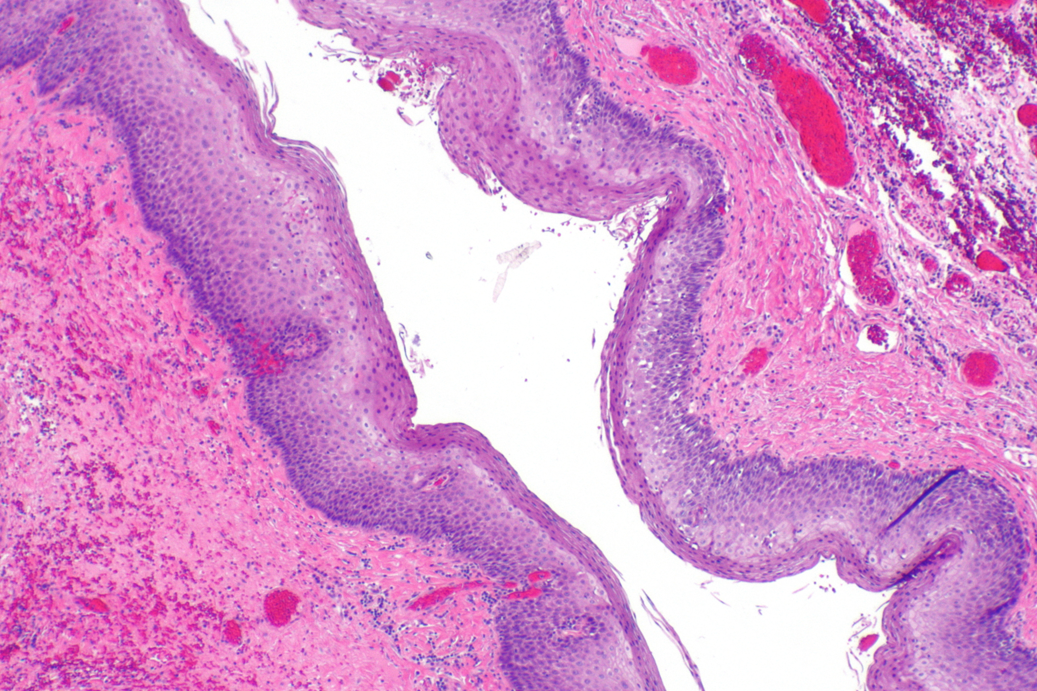 Planifier avec​ précision pour un traitement‍ chirurgical efficace⁢ des diverticules œsophagiens : Considérations ⁢essentielles