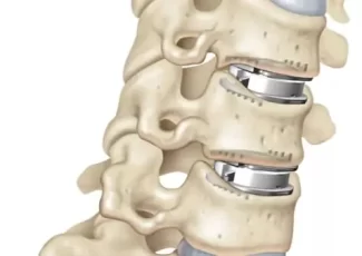 Prothèse Discale Lombaire Ou Cervicale