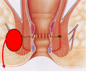 Réparation Du Sphincter Anal