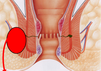 Réparation Du Sphincter Anal