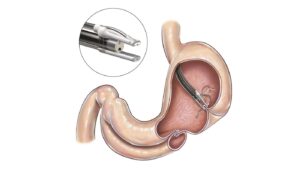 Résection Endoscopique Pleine Épaisseur