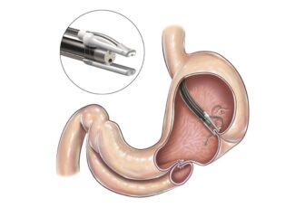 Résection Endoscopique Pleine Épaisseur