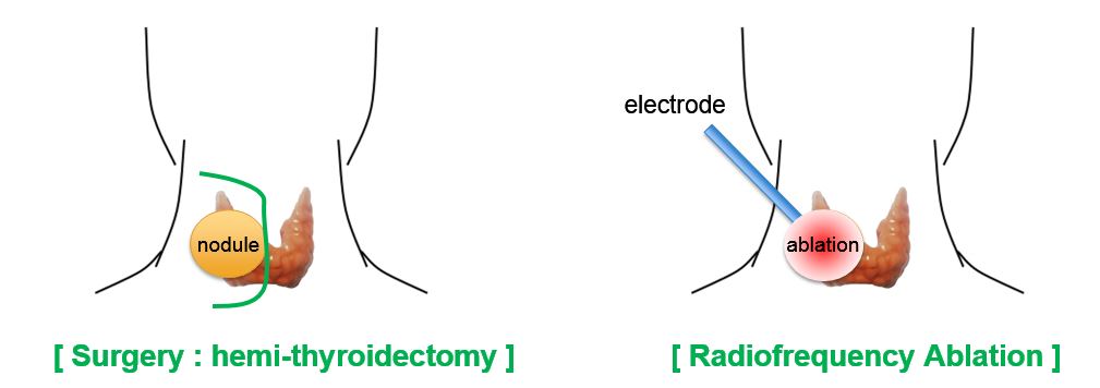 2. La prise en fee submit-opératoire :⁤ Des conseils essentiels pour un rétablissement rapide⁤ et optimal ⁢après une thyroïdectomie