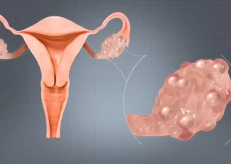 Traitement Du Syndrome Des Ovaires Polykystiques