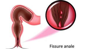 Traitement Des Fissures Anales