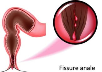 Traitement Des Fissures Anales