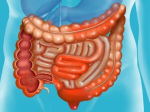 Traitement De La Maladie De Crohn