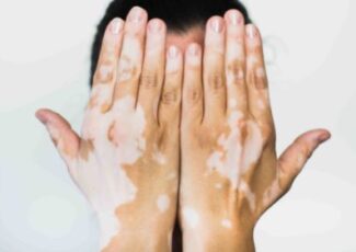 Traitement Du Vitiligo