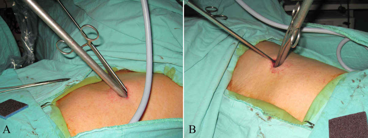 Résection Endoscopique Pleine⁣ Épaisseur ,