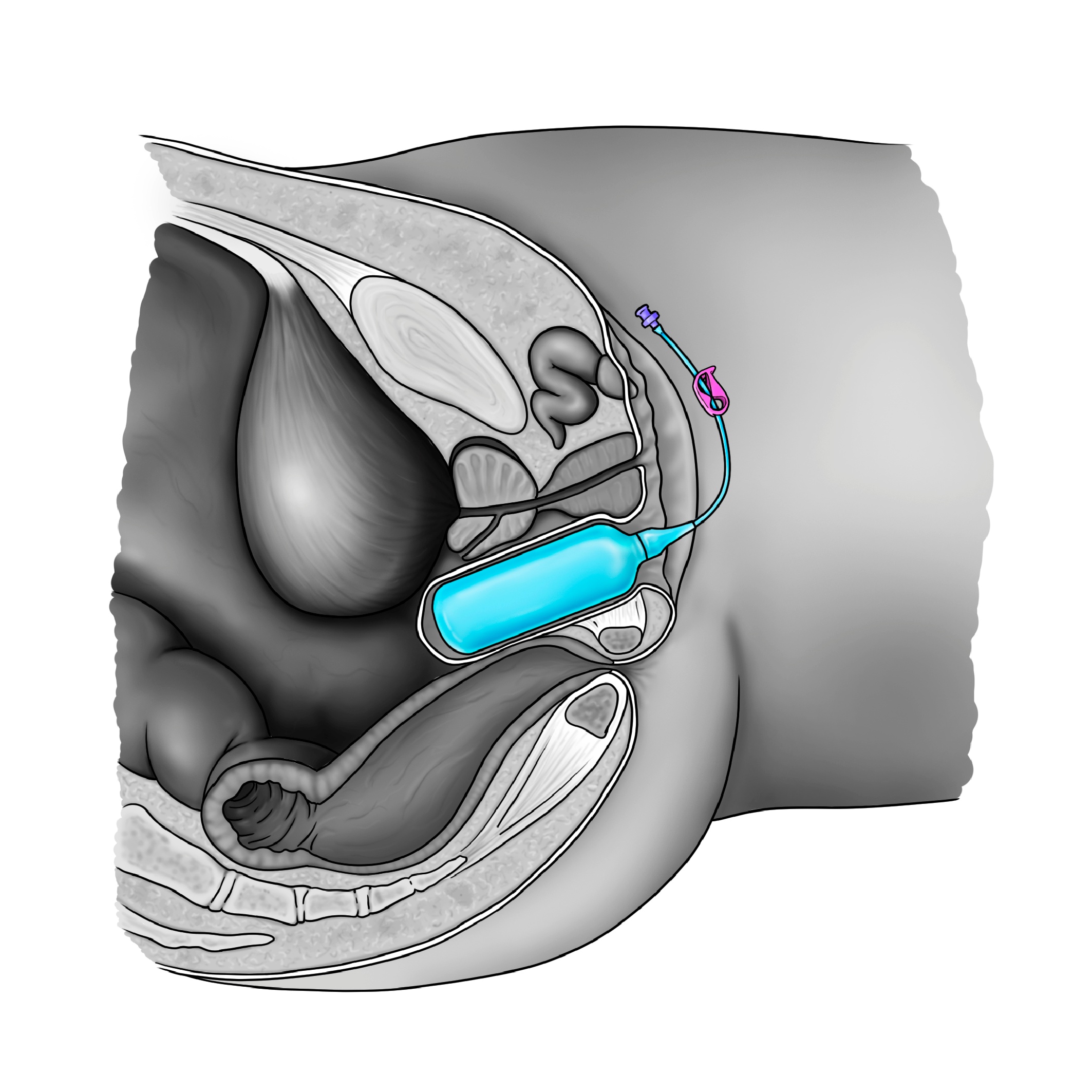 Une answer sûre et innovante pour se sentir⁣ bien dans son corps : la⁢ vaginoplastie