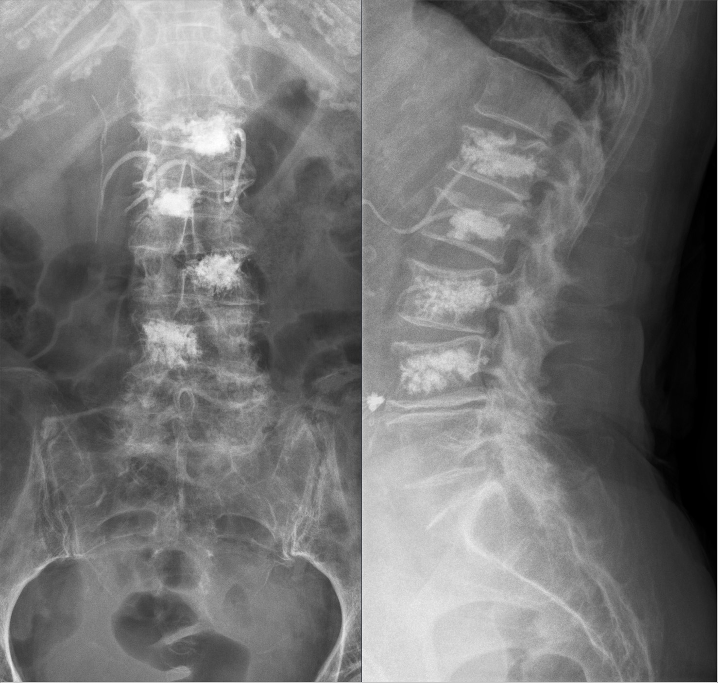 Dévoilez une nouvelle perspective : Redécouvrez une posture⁣ verticale grâce à la kyphoplastie