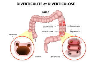 Traitement De La Diverticulite