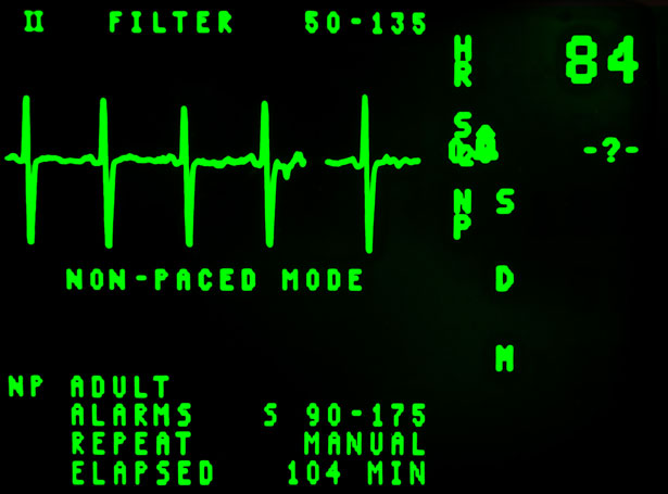 Electrocardiogramme,