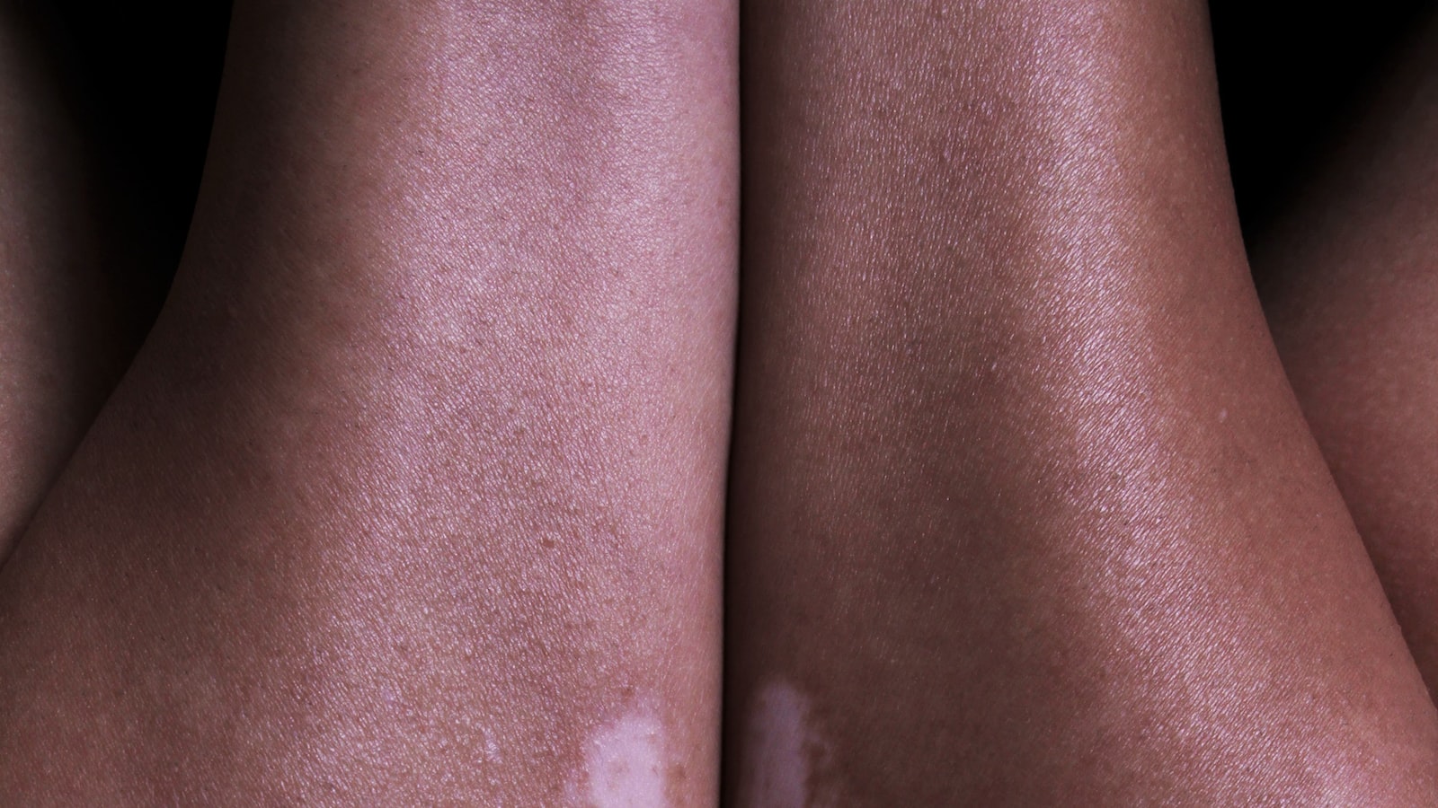 1. Briser ‍les barrières du Vitiligo : Redéfinir la beauté et promouvoir l'acceptation de‌ soi